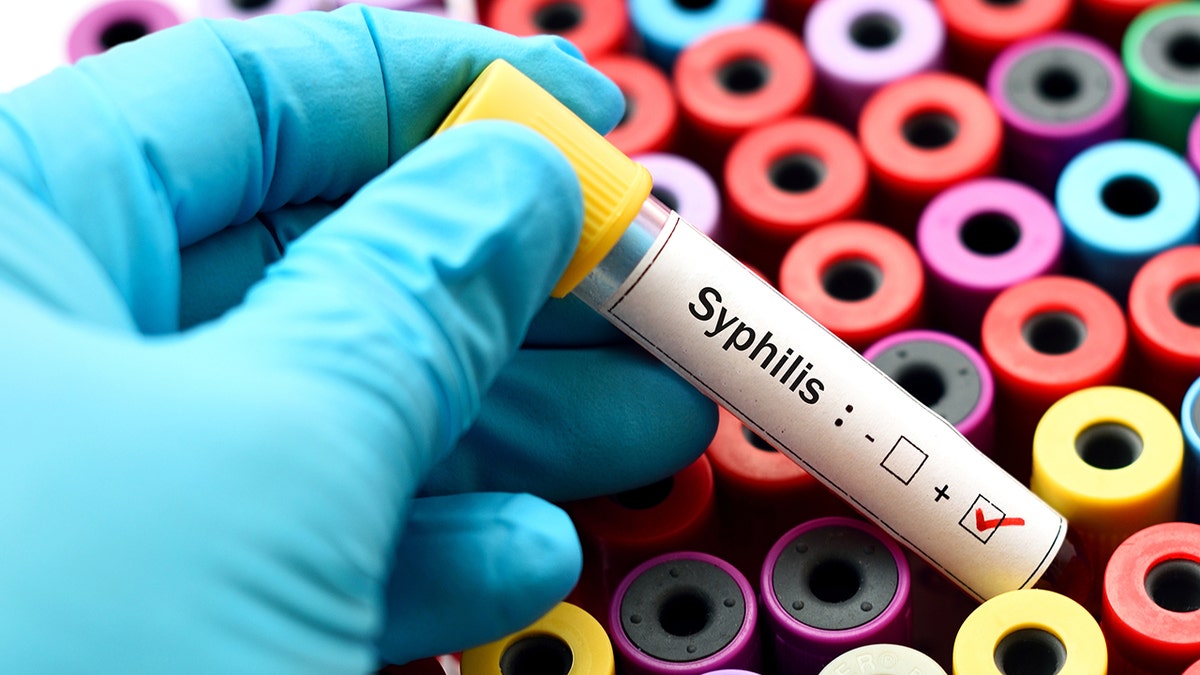 Blood sample positive with syphilis