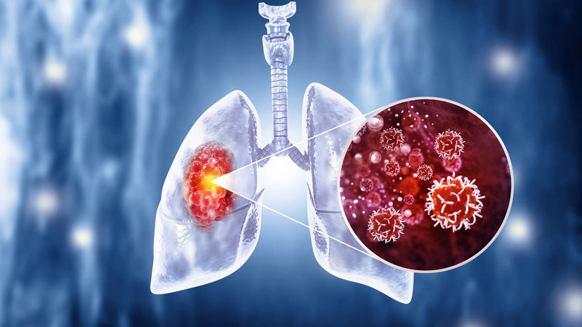 Lung cancer illustration 