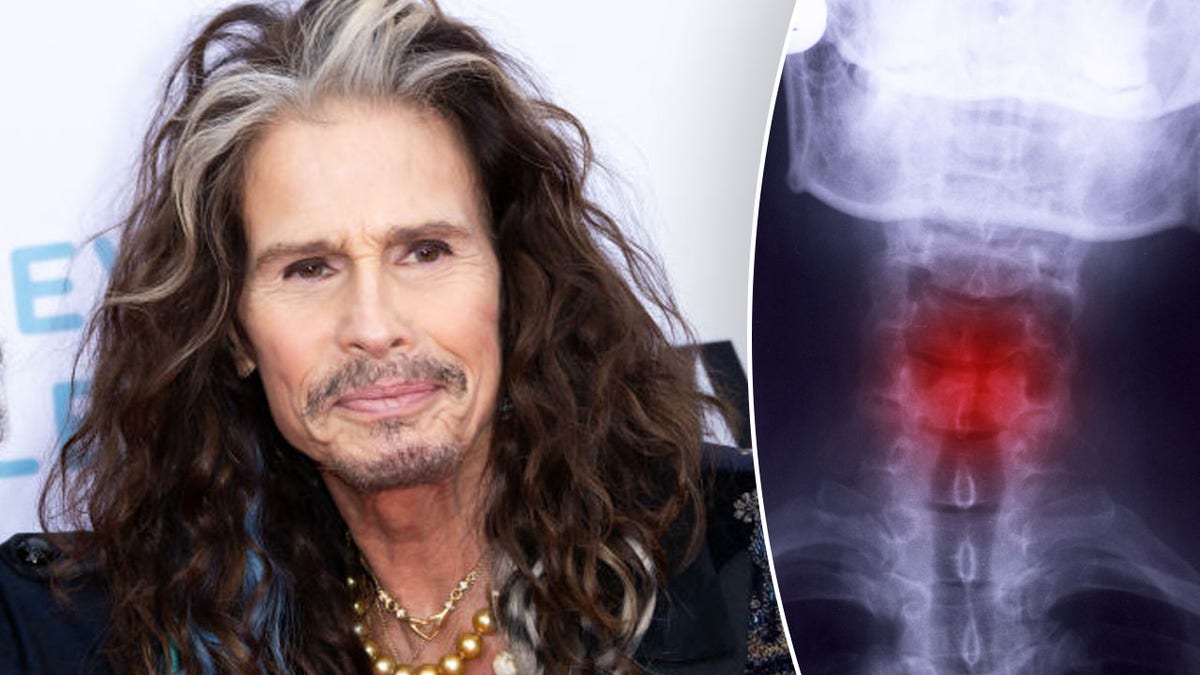 Steven Tyler’s careerending throat injury What is a fractured larynx