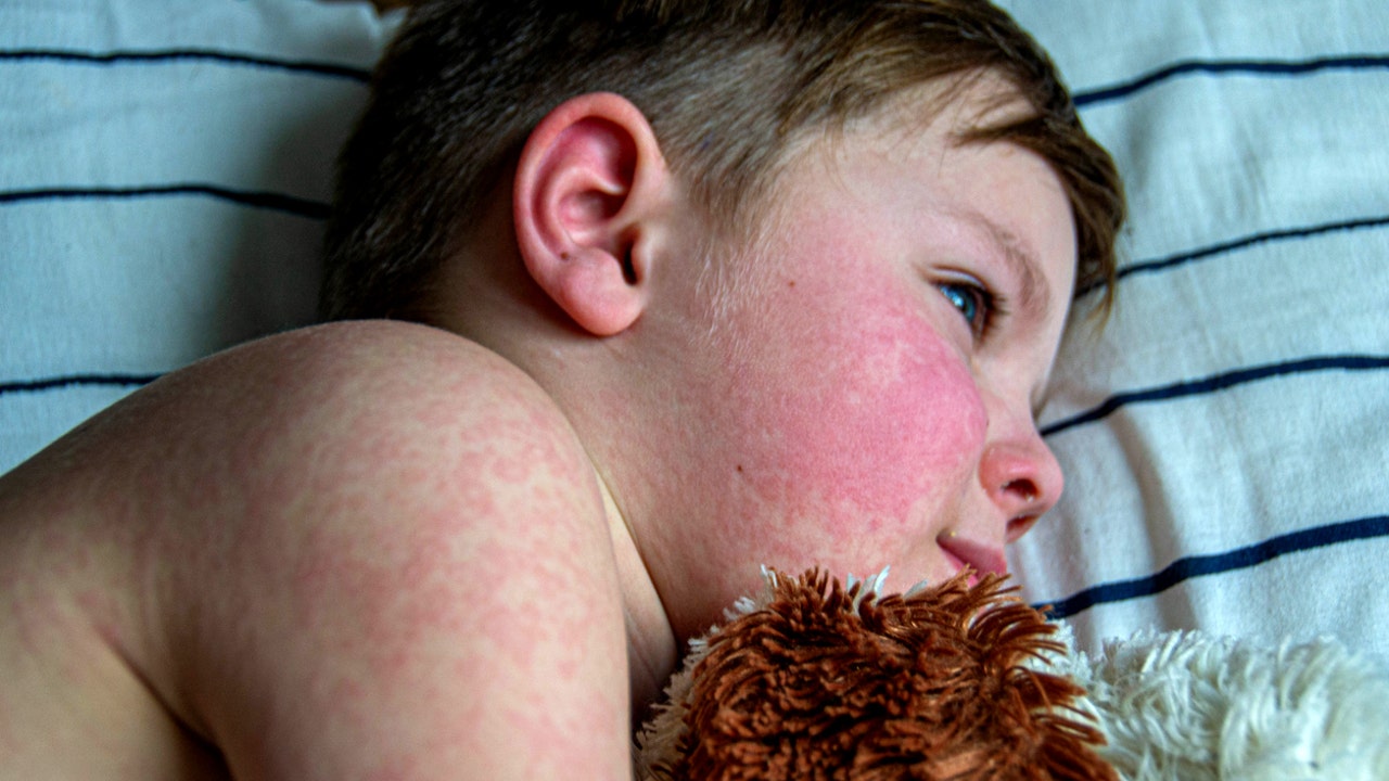 Stress Rash In Kids Stress Rash On Face Kids
