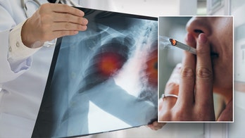 Risks, symptoms and treatments for lung cancer, the deadliest cancer in the world