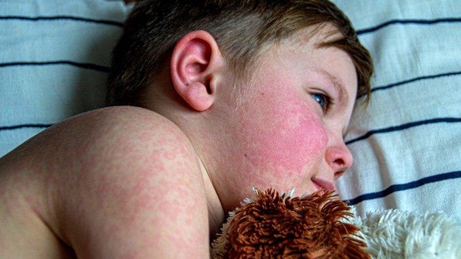 Parvovirus or ‘slapped cheek disease’ is on the rise, CDC warns: Here’s what to know