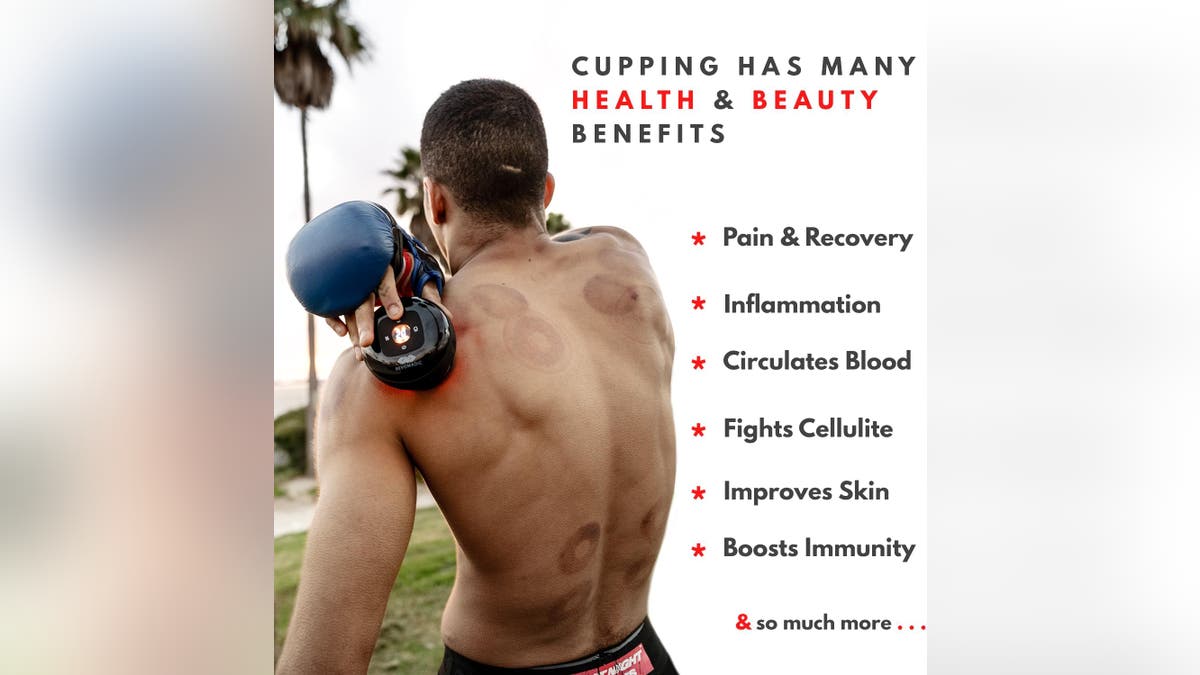 Cupping is an alternative therapy that is quickly gaining popularity.