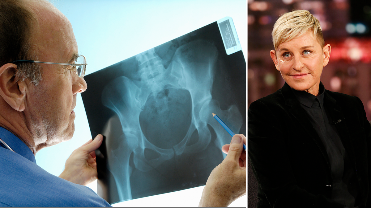 gambar terpisah dari rontgen pinggul dan Ellen DeGeneres