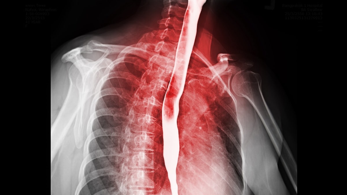 Esophagram