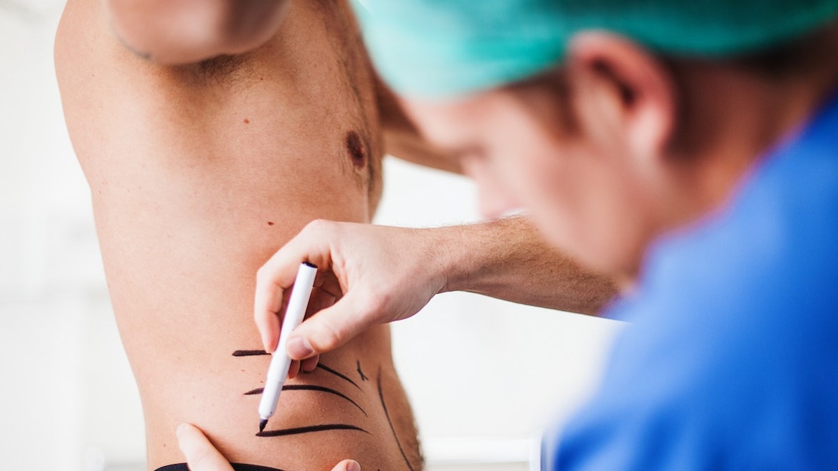 surgeon is marking a man