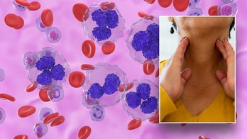 Lymphoma signs, symptoms, common treatment options for the blood cancer