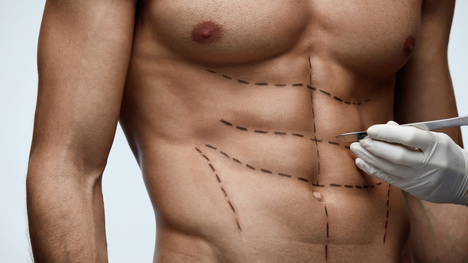 ‘Six-pack surgery’ gaining popularity among men, say plastic surgeons