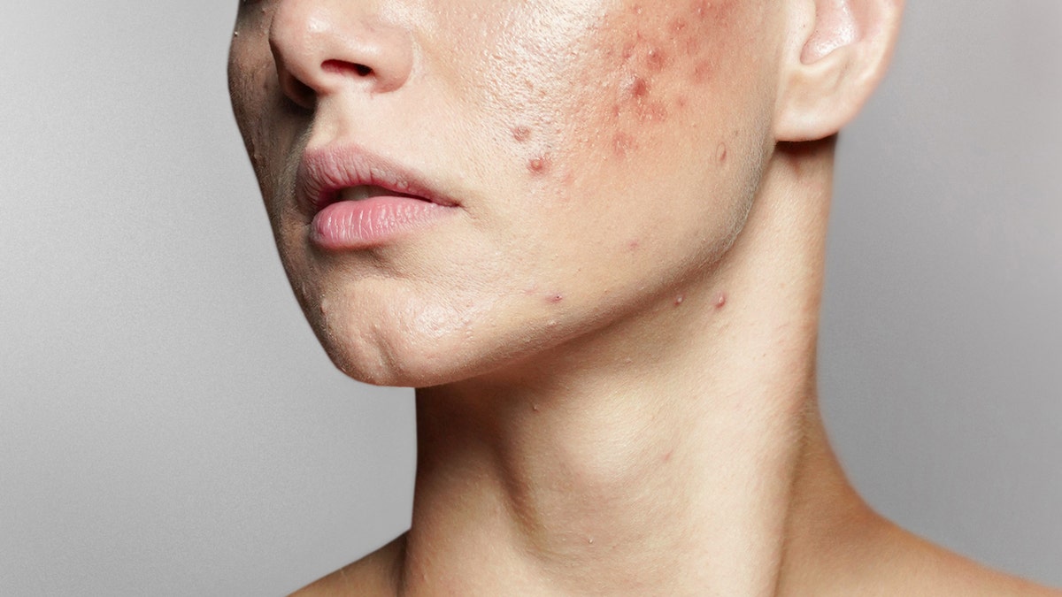 Acne on woman's face