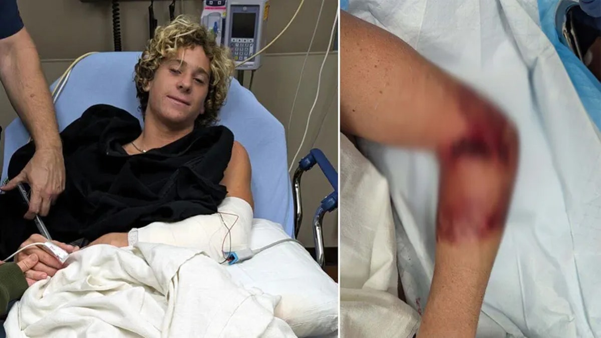 Florida teen   surfer bitten by shark