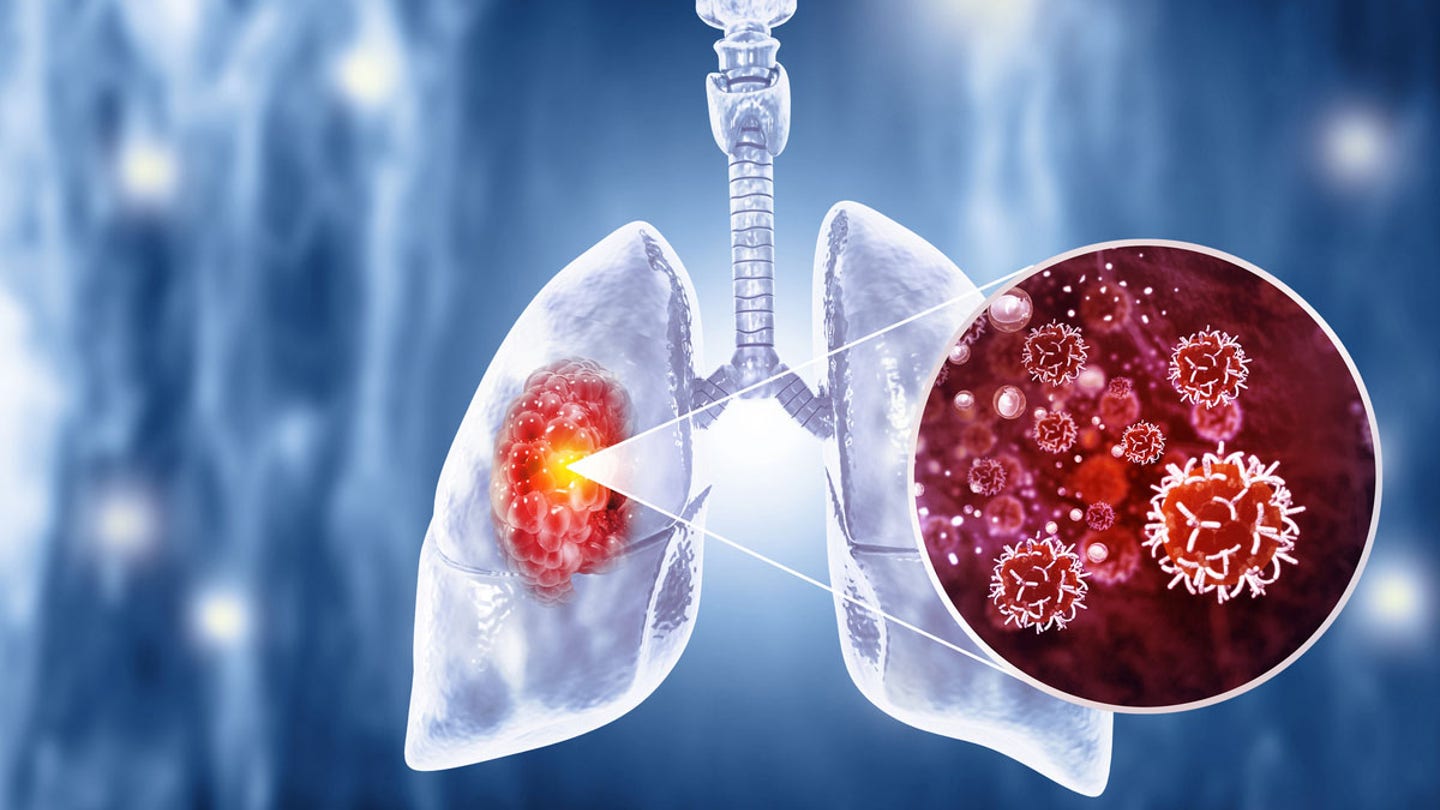 lung infection