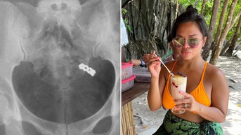 'Beyond jet-lagged' woman accidentally swallows wedding ring while taking vitamins - Fox News