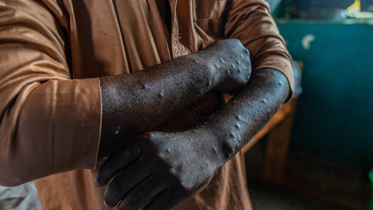 Mpox Outbreak: Risk to Public Remains Low as First U.S. Case of New Strain is Identified