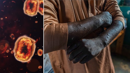 First known case of rare mpox strain confirmed in US