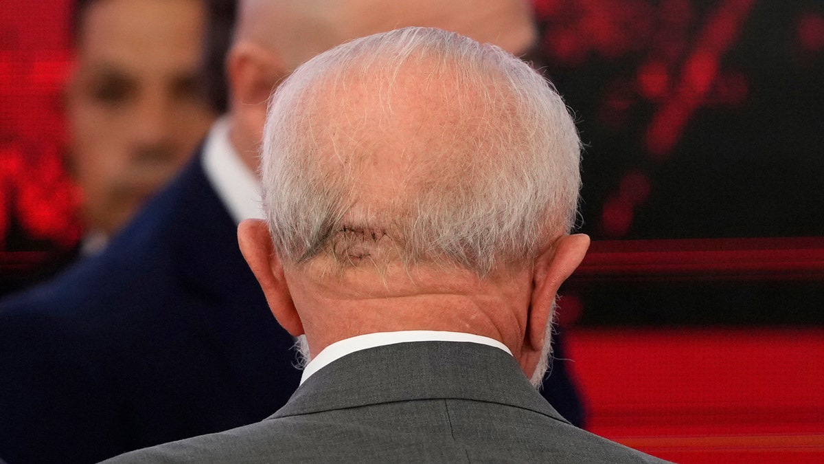 The back of Brazilian President Luiz Inácio Lula da Silva's head shows stitches.