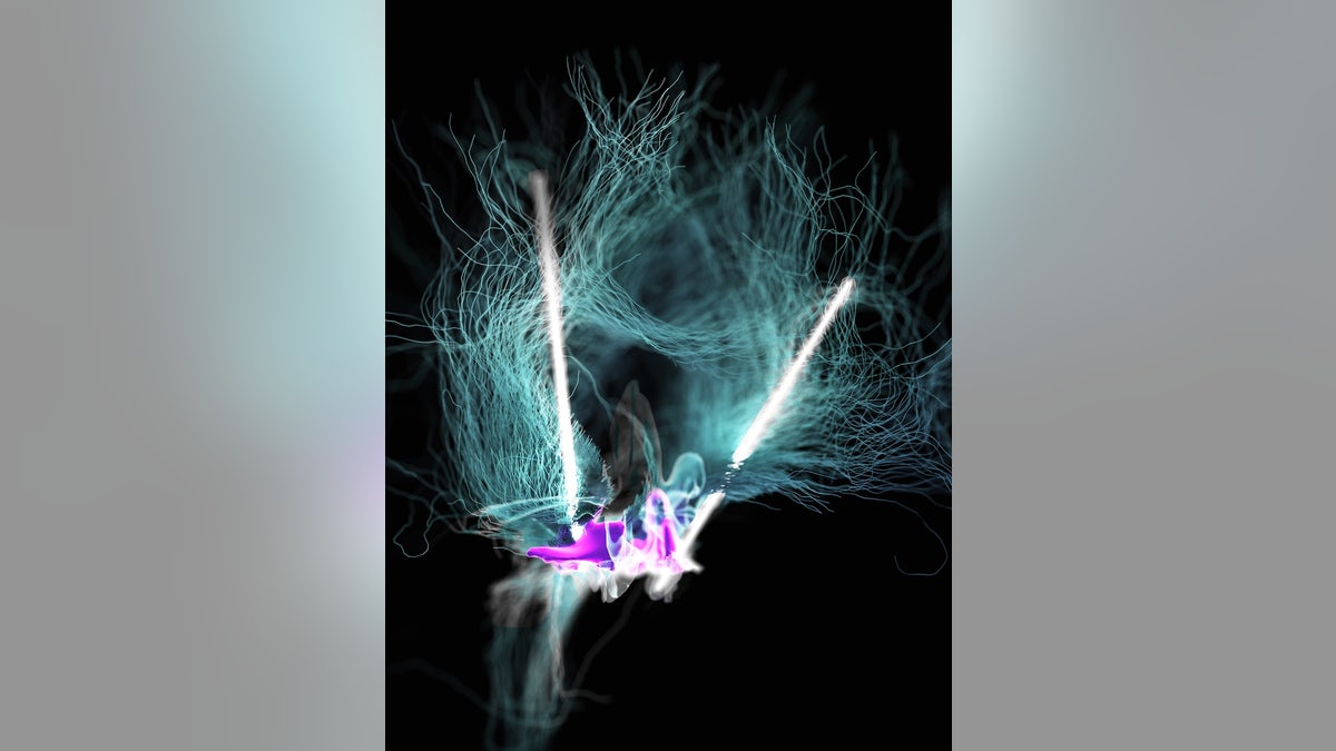 A visual representation of the deep brain stimulation of the of the lateral hypothalamus