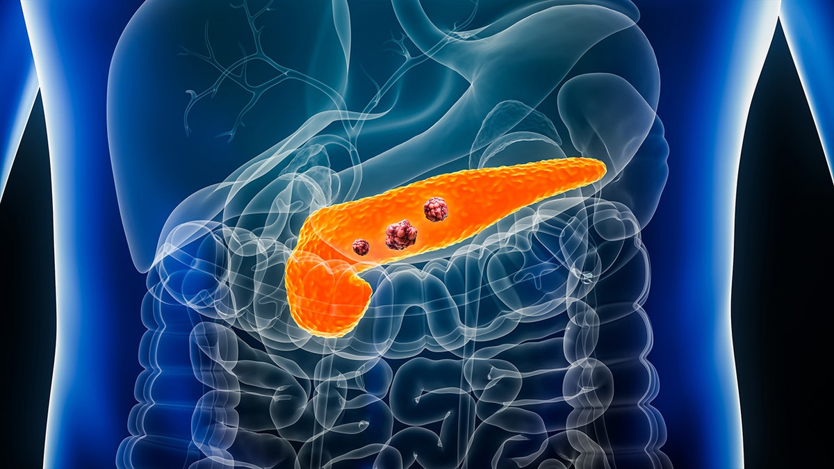 Pancreatic cancer 3D imaging