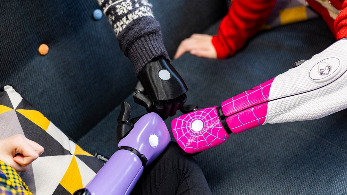 three kids get bionic arms