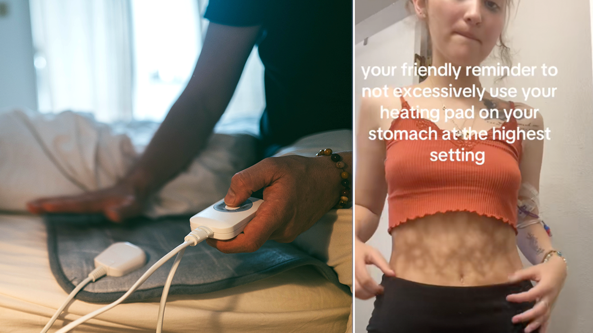 split image of heated blanket remote and girl with toasted skin syndrome