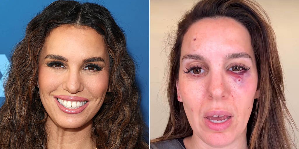 Christy Carlson Romano Injured in Clay Pigeon Shooting Incident