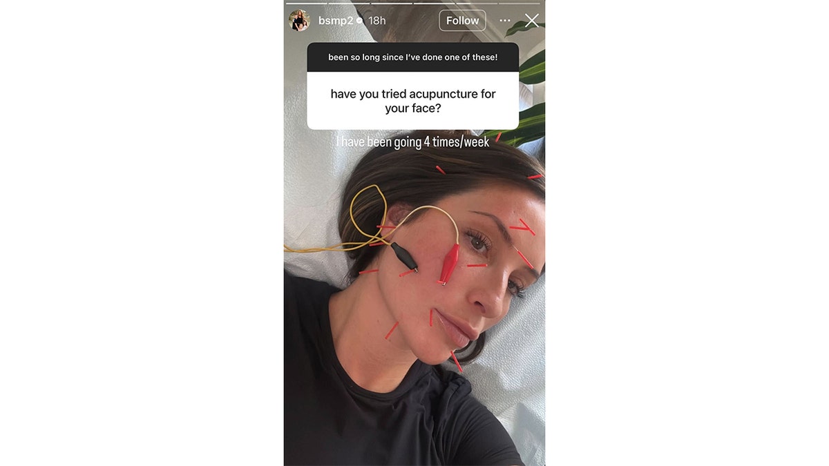 Bristol Palin does acupuncture