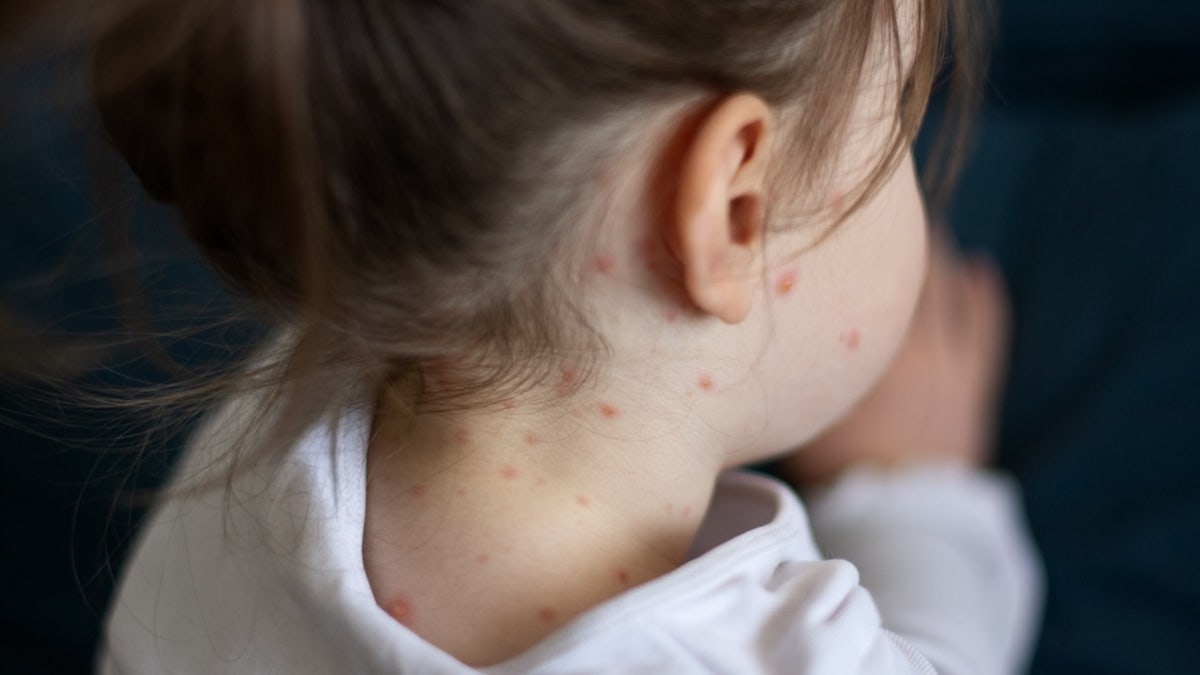 Children with measles