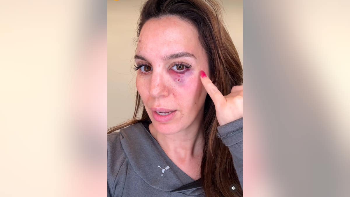 christy carlson romano pointing to injury on side of face