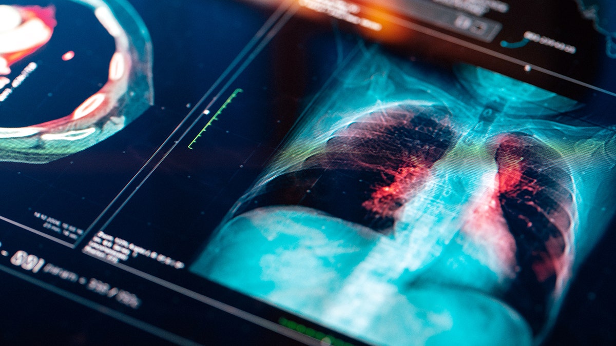 scan of lung cancer