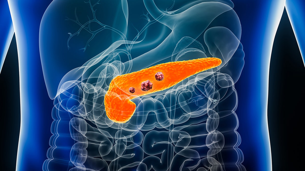 illustration of pancreas with cancerous cells