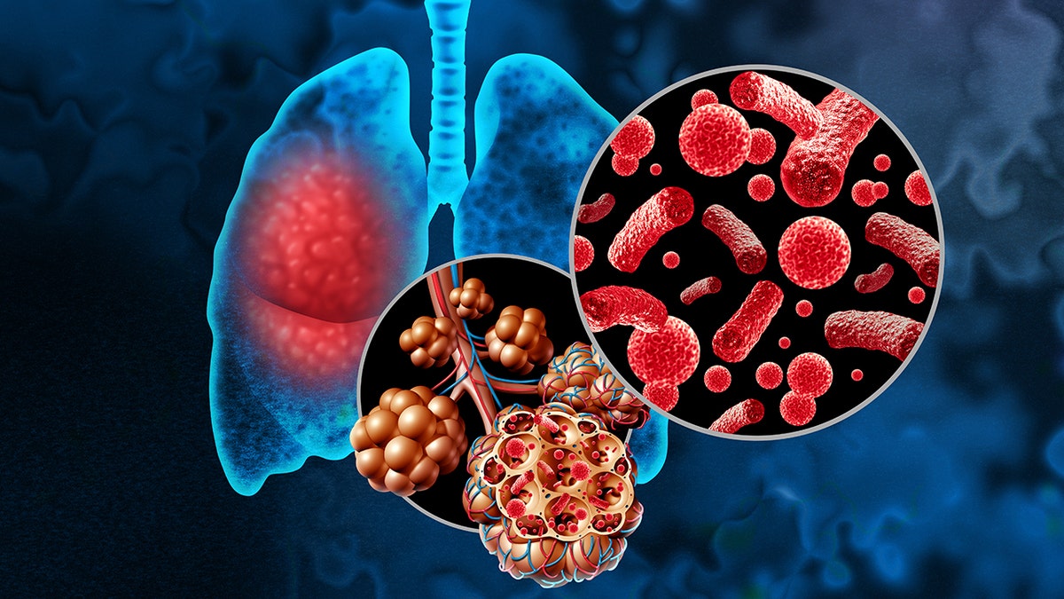 Pneumonia in the lungs