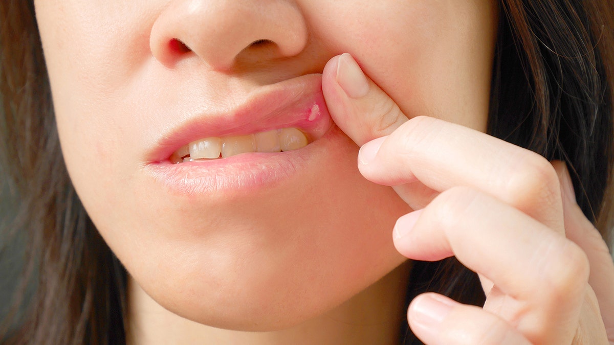 Canker sore on woman upper lip