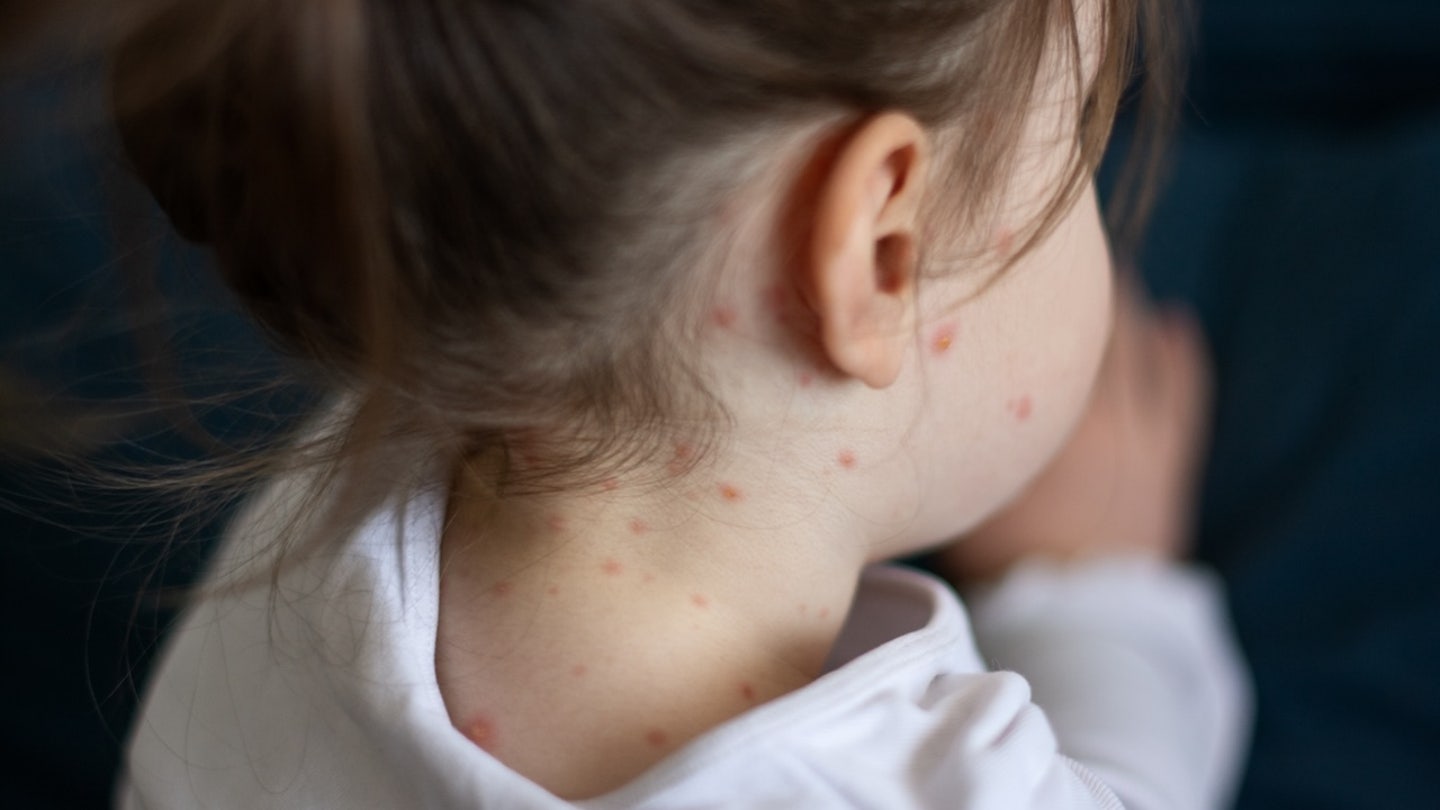 child with measles