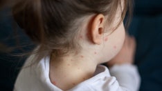 Measles cases continue to spread in multiple states following child’s death