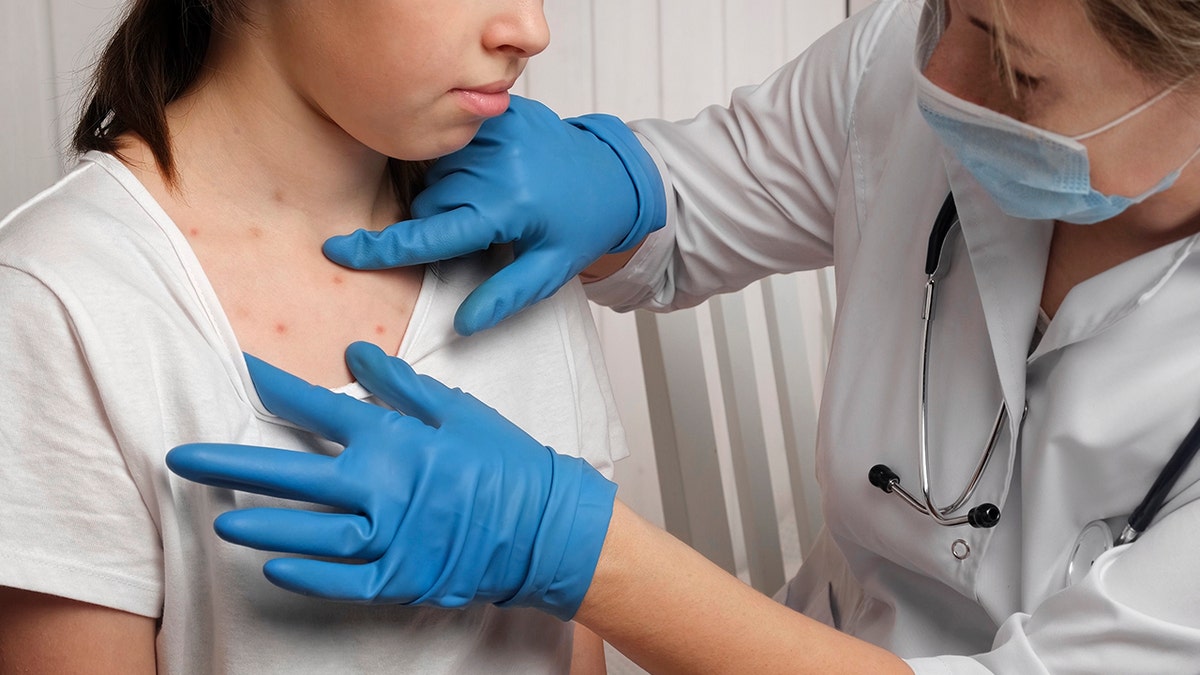 Girl with measles wounds on her chest