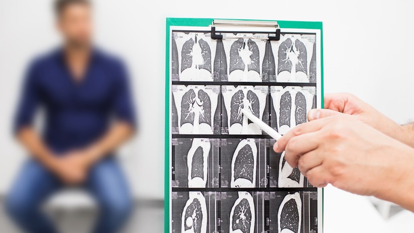 lungs ct scan