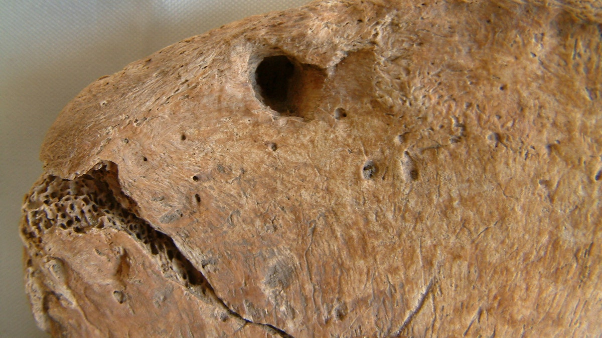 Punctured pelvis