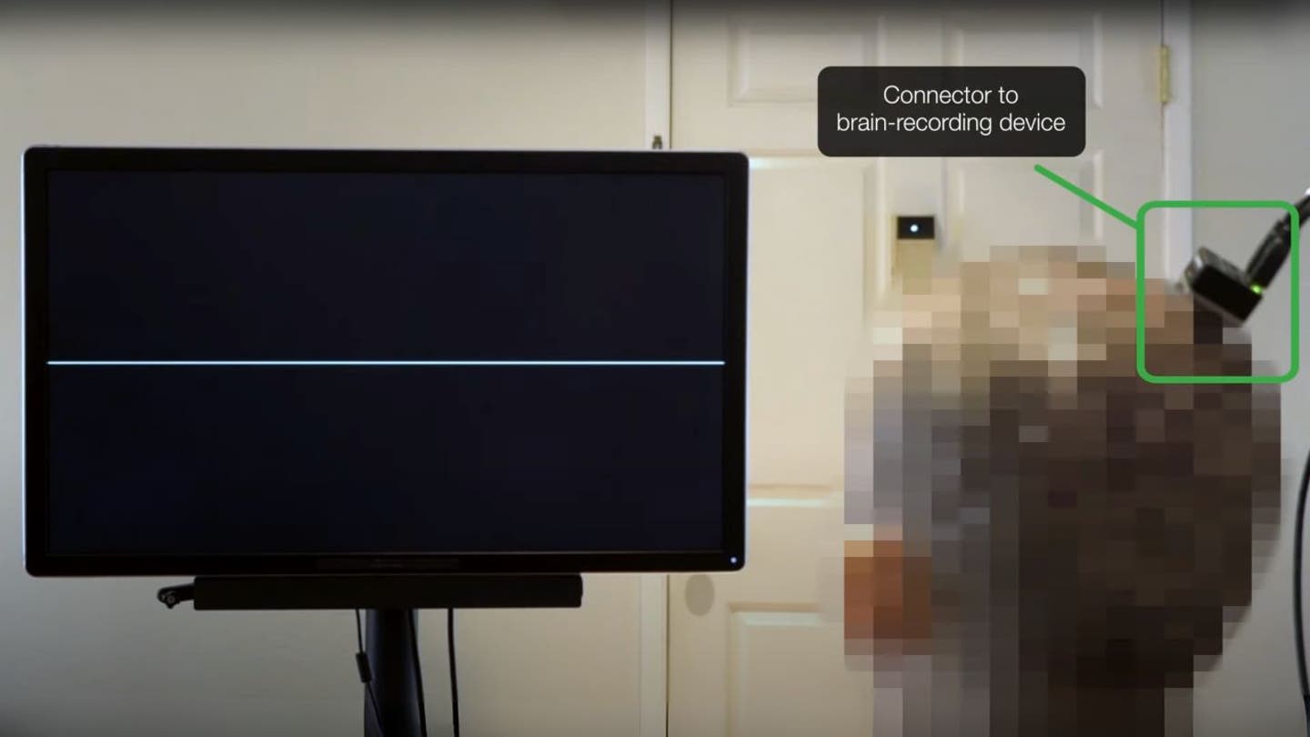 1 ai system restores natural speech for paralyzed patients using their own voices