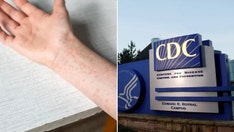 Texas measles outbreak swells to 561 cases, CDC sends more help