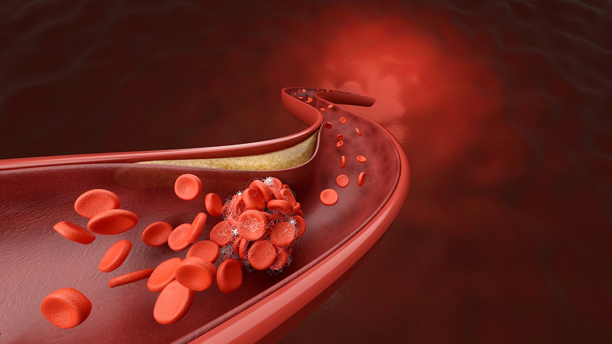 coronary artery and blood clot disease, Blood cell blocked by cholesterol or fat metaphor hyperlipidemia and embolic stroke. 3D rendering.