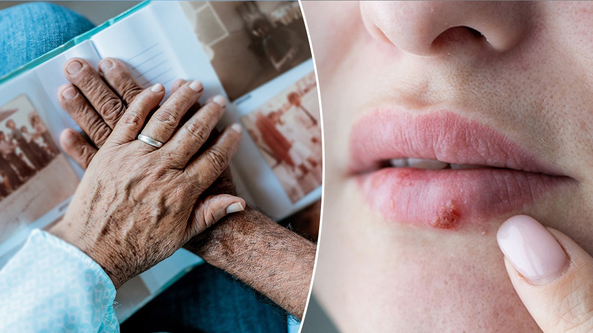 Side by side of elderly hands over a photograph, and a cold sore up close