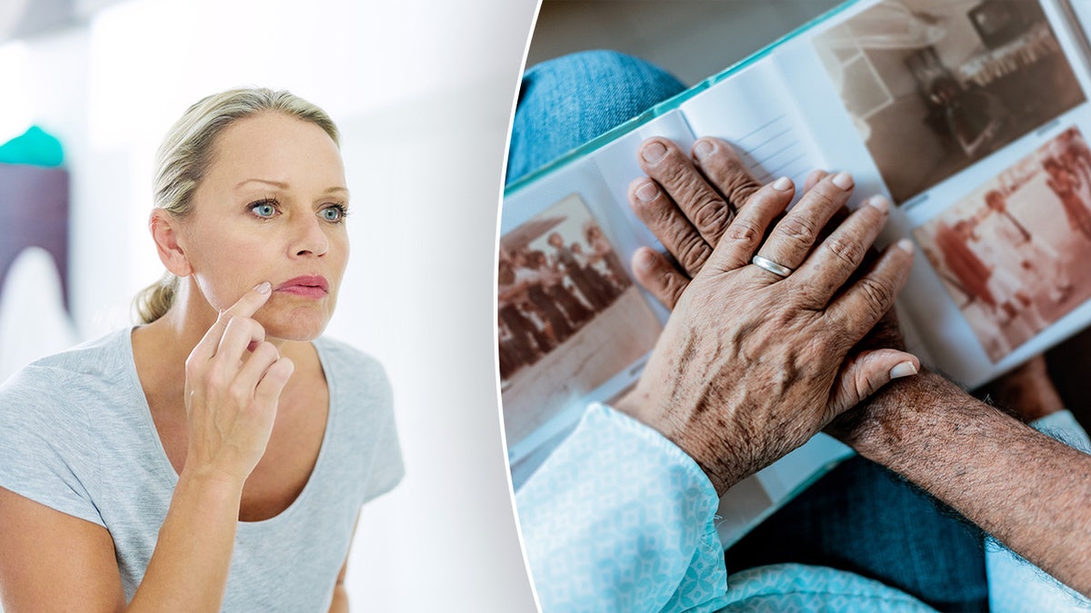 Cold sore split with Alzheimer's picture
