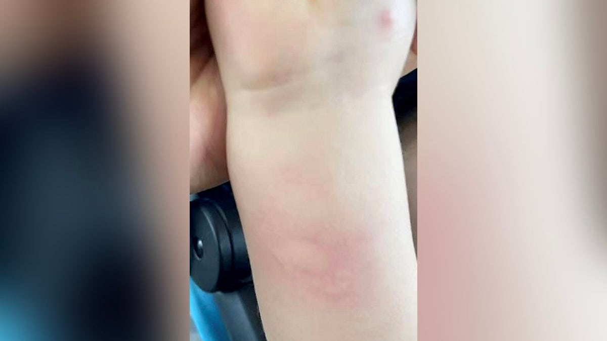 Baby's forearm (zoomed in) showing rash along forearm, bug bites