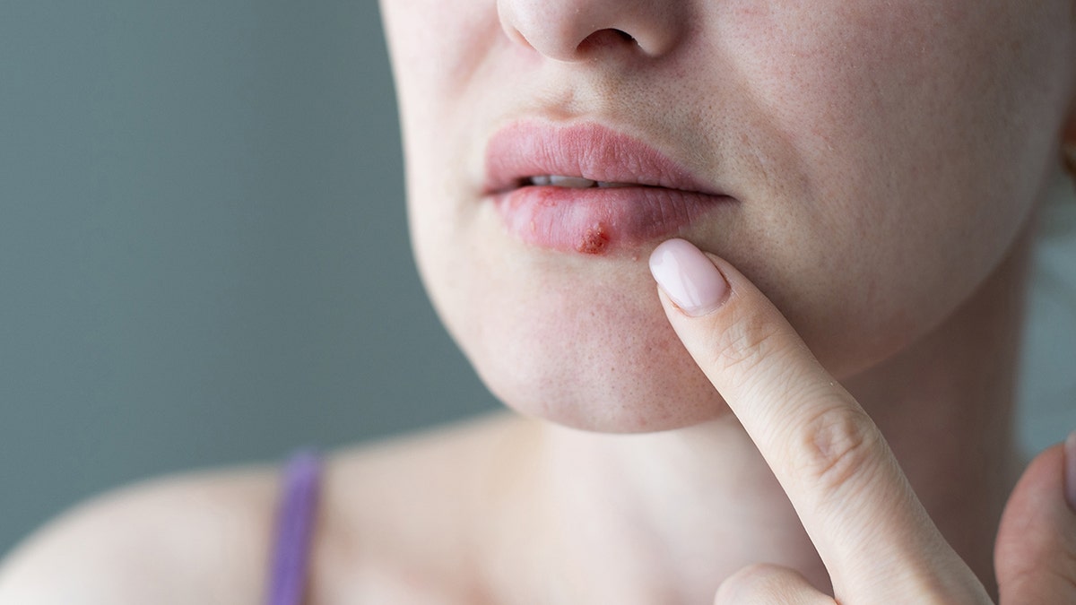 Woman with coldsore, upclose shot of her mouth