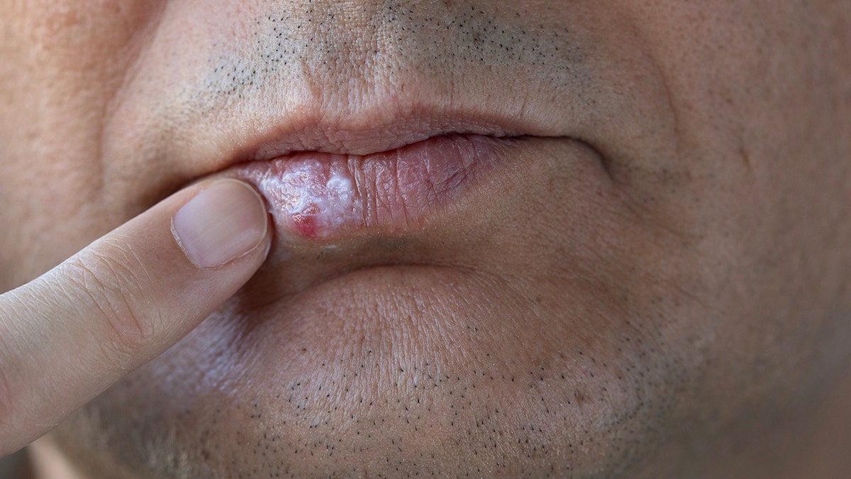 Man with cold sore (only mouth pictured) applying cream to his lips.