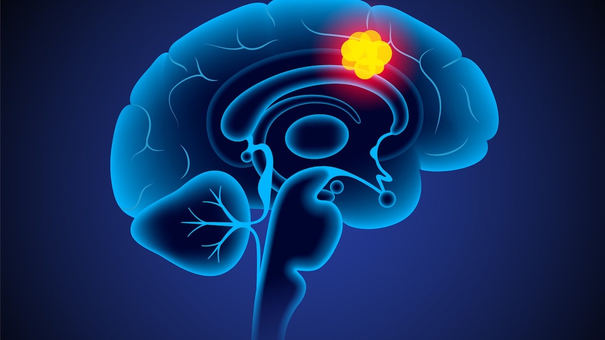 Glioblastoma
