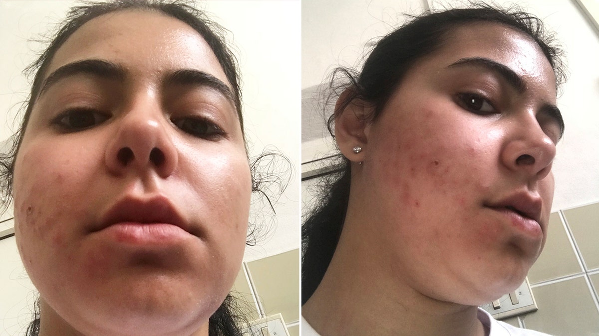 This split photo by Kyleigh Digiovanni shows how her face became swollen after being exposed to mint toothpaste on someone's breath.