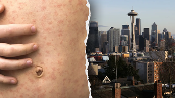 Officials in West Coast state sound alarm after traveler diagnosed with viral disease - Fox News
