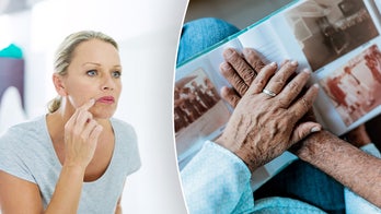 Cold sores may play role in Alzheimer's development, new research reveals