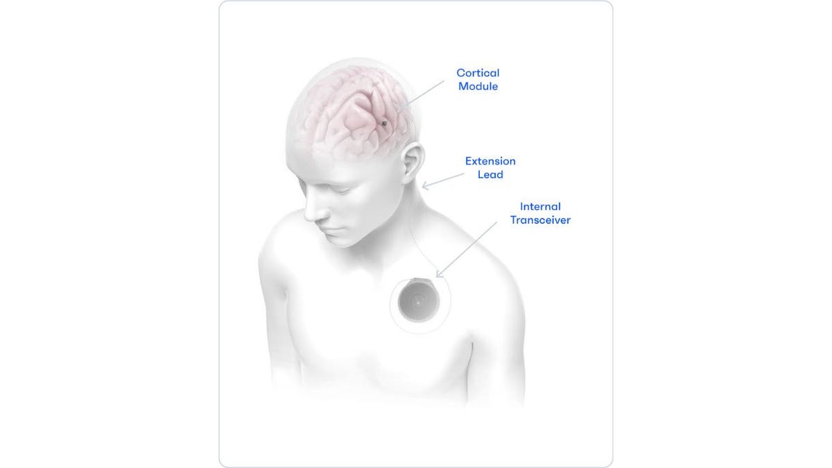 brain implant 7