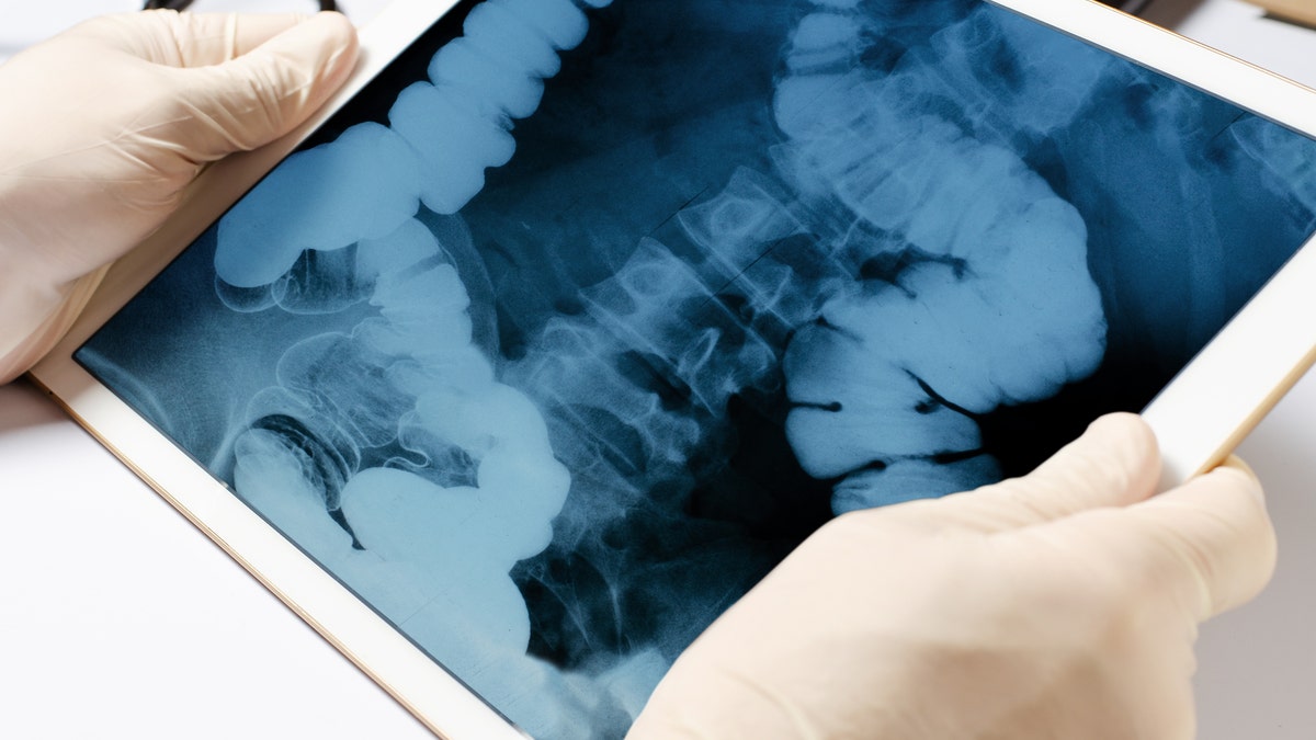 Intestine X-ray
